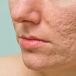 3 Jenis Bopeng Bekas Jerawat: Kenali Perbedaannya dan Pilihan Treatment