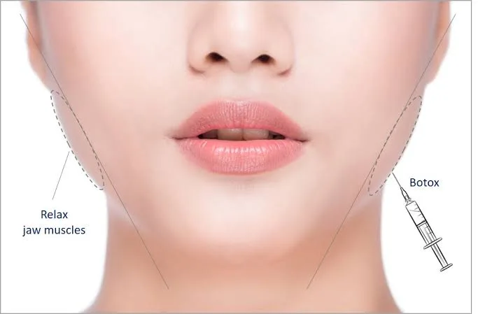 Botox Rahang: Cara Kerja, Manfaat, dan Siapa yang Cocok Melakukannya