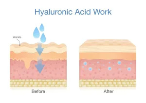 Cara Kerja Filler dengan HA