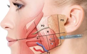 Ilustrasi Injeksi Botox Rahang