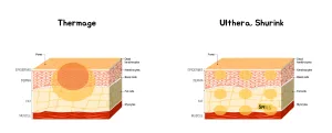 Cara Kerja Thermage vs Ulthera
