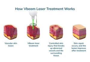 Cara Kerja Laser vBeam