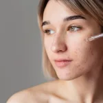 Cara Mengatasi Fungal Acne: Kenali Dulu Bedanya dengan Jerawat Biasa