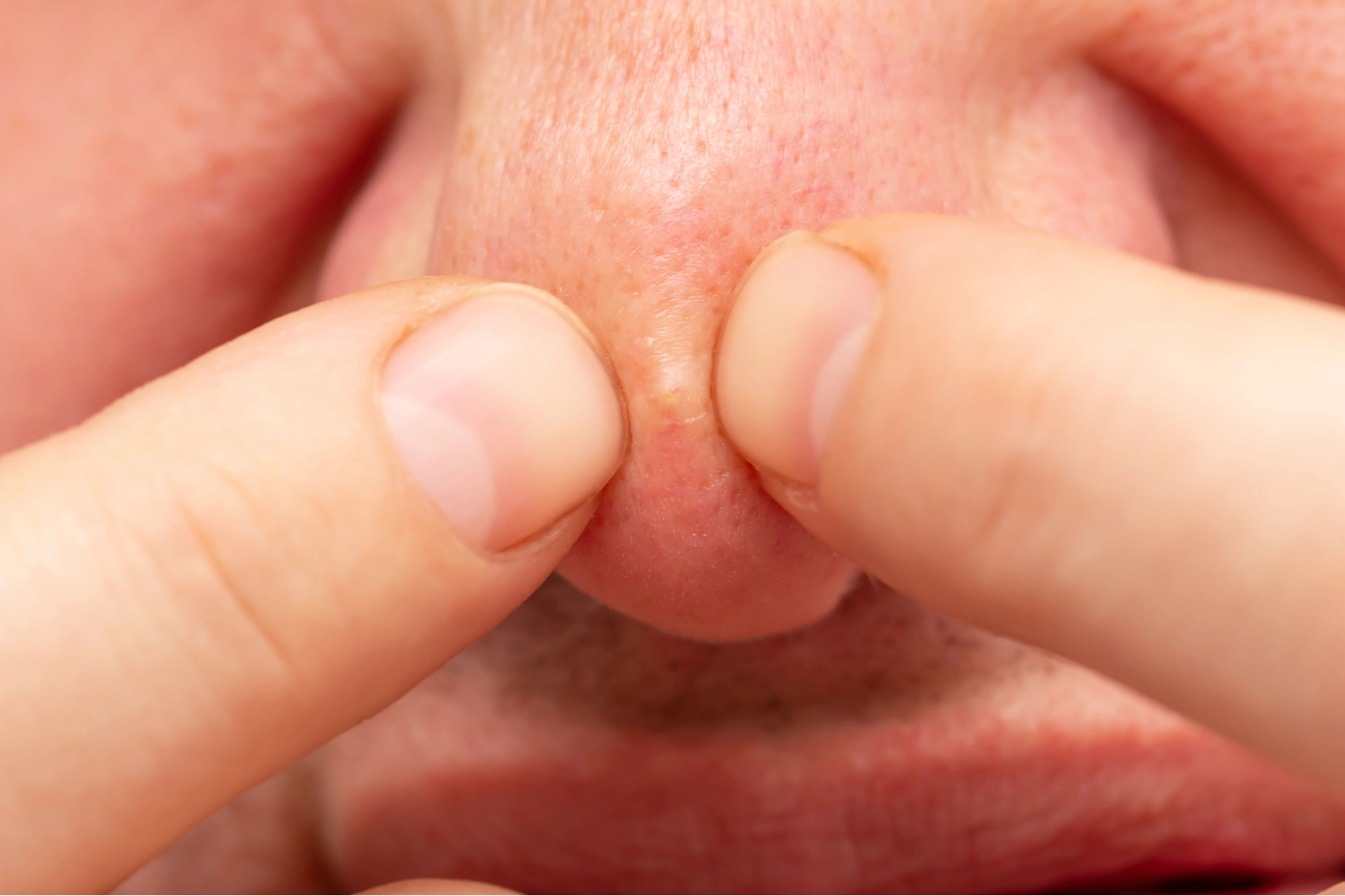 Jerawat Batu di Hidung Bikin Nyeri? Ini Penyebab dan Cara Mengatasinya