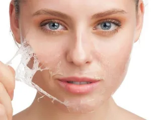 Ilustrasi Chemical Peeling