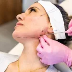 Efek Samping Threadlift (Tanam Benang) yang Perlu Kamu Tahu Sebelum dan Sesudah Treatment