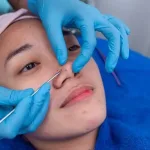 Sering Memencet Komedo Sendiri? Ketahui Bahayanya dan Solusi Ekstraksi Aman di Klinik