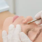 Ekstraksi Komedo pada Facial: Manfaat dan Hal yang Perlu Diperhatikan