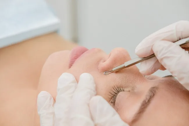 Ekstraksi Komedo pada Facial: Manfaat dan Hal yang Perlu Diperhatikan