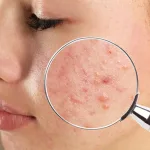 Facial Treatment untuk Membantu Mengurangi Tampilan Bekas Jerawat