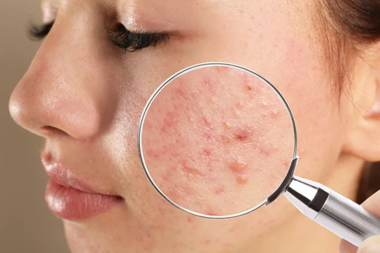 Facial Treatment untuk Membantu Mengurangi Tampilan Bekas Jerawat