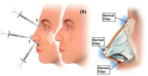 Cara Kerja Filler Hidung
