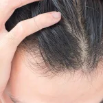 Folikel Rambut Mati atau Cuma Melemah? Ini Cara Mengenali Bedanya