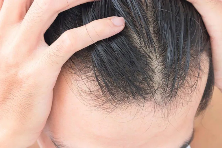 Folikel Rambut Mati atau Cuma Melemah? Ini Cara Mengenali Bedanya