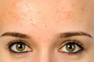 fungal acne