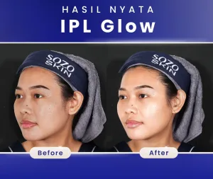 Hasil IPL Glow Treatment