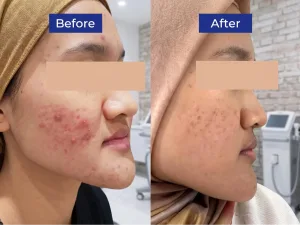 Hasil Acne Treatment