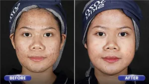 Hasil Acne Treatment