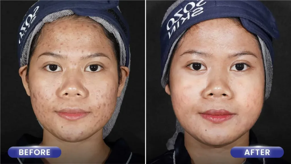 Hasil Acne Treatment