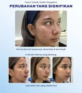 Hasil Acne Treatment