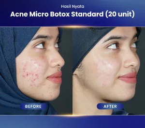 Hasil Acne Treatment