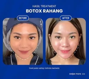 Hasil Botox Rahang