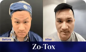 Hasil Botox (Zo-Tox) Treatment