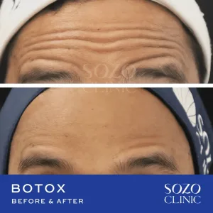 Hasil Botox Treatment