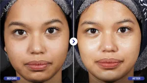 Hasil Skin Booster