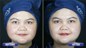 Hasil Acne Treatment