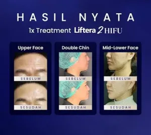 Hasil HIFU Treatment
