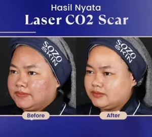 Hasil Laser Treatment