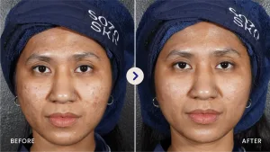 Hasil Peeling Jerawat