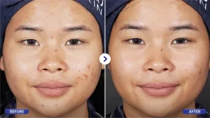 Hasil Pico Laser Treatment