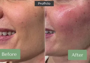 Hasil Profhilo Treatment