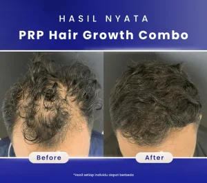 Hasil PRP Hair Growth