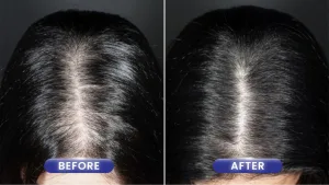 Hasil PRP Rambut