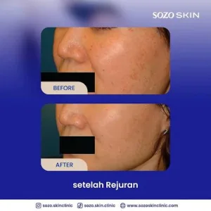 Hasil Rejuran
