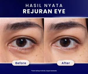 Hasil Rejuran Eye Treatment