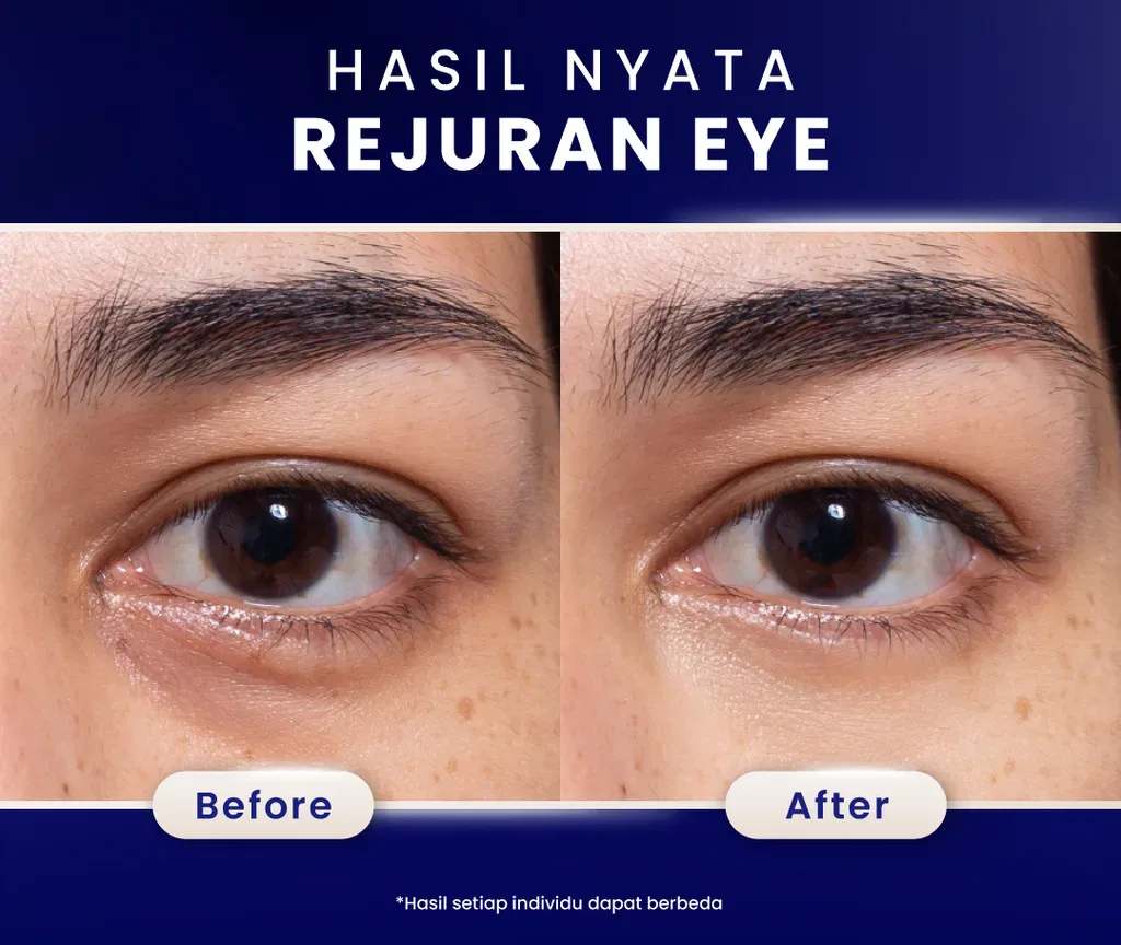 Hasil Rejuran Eye Treatment