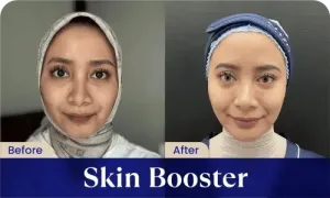 Hasil Skin Booster
