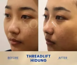 Hasil Threadlift Hidung