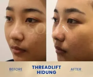 Hasil Tanam Benang Hidung