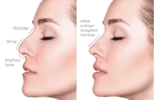 Ilustrasi Tarik Benang Hidung