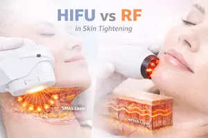 HIFU vs RF