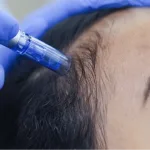 Salmon DNA Hair untuk Atasi Rambut Rontok: Begini Cara Kerjanya Merangsang Folikel