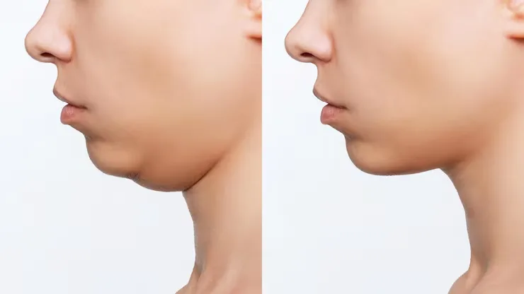 HIFU untuk Double Chin: Cocok untuk Kamu atau Tidak? Cek Penyebabnya Dulu