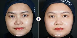 Hasil Facial Treatment