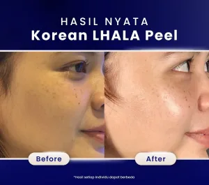Hasil Chemical Peeling