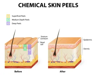 Cara Kerja Chemical Peeling